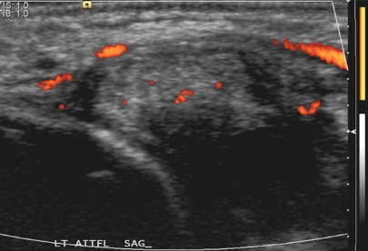 Figure 3 for case AITFL Desmitis